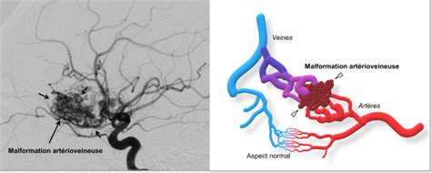 mavc|malformation artério veineuse cérébrale pdf.